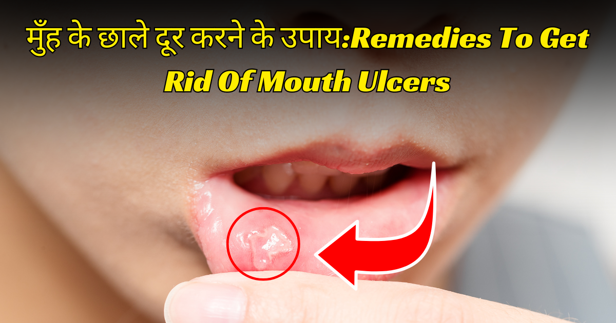 मुँह के छाले दूर करने के उपायRemedies To Get Rid Of Mouth Ulcers